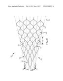 ENDOVASCULAR DEVICE ENGAGEMENT diagram and image