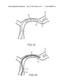 ENDOVASCULAR DEVICE ENGAGEMENT diagram and image