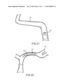 ENDOVASCULAR DEVICE ENGAGEMENT diagram and image