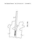 METHODS AND APPARATUS FOR AN INSERTION GUIDE DEVICE diagram and image