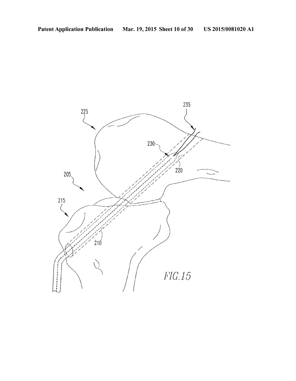 HELICOIL INTERFERENCE FIXATION SYSTEM FOR ATTACHING A GRAFT LIGAMENT TO A     BONE - diagram, schematic, and image 11