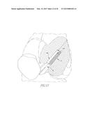 HELICOIL INTERFERENCE FIXATION SYSTEM FOR ATTACHING A GRAFT LIGAMENT TO A     BONE diagram and image