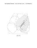 HELICOIL INTERFERENCE FIXATION SYSTEM FOR ATTACHING A GRAFT LIGAMENT TO A     BONE diagram and image