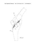 HELICOIL INTERFERENCE FIXATION SYSTEM FOR ATTACHING A GRAFT LIGAMENT TO A     BONE diagram and image