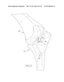 HELICOIL INTERFERENCE FIXATION SYSTEM FOR ATTACHING A GRAFT LIGAMENT TO A     BONE diagram and image