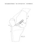 HELICOIL INTERFERENCE FIXATION SYSTEM FOR ATTACHING A GRAFT LIGAMENT TO A     BONE diagram and image