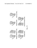 Use of TNFalpha Inhibitor for Treatment of Erosive Polyarthritis diagram and image