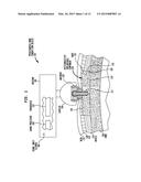 Osteoconductive Implantable Component for a Bone Conduction Device diagram and image