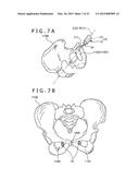 METHOD OF PLACING IMPLANT INDWELLING diagram and image