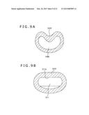 METHOD OF PLACING IMPLANT INDWELLING diagram and image