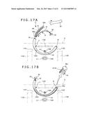 METHOD OF PLACING IMPLANT INDWELLING diagram and image