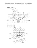 METHOD OF PLACING IMPLANT INDWELLING diagram and image