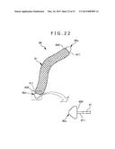 METHOD OF PLACING IMPLANT INDWELLING diagram and image