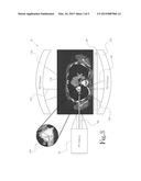 POSITRON EMISSION TOMOGRAPHY GUIDED PROTON THERAPY diagram and image