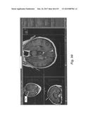 IMAGE-GUIDED THERAPY OF A TISSUE diagram and image