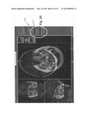 IMAGE-GUIDED THERAPY OF A TISSUE diagram and image