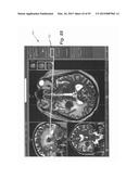 IMAGE-GUIDED THERAPY OF A TISSUE diagram and image