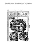 MONITORING AND NOISE MASKING OF THERMAL THERAPY diagram and image