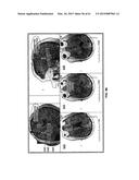 MONITORING AND NOISE MASKING OF THERMAL THERAPY diagram and image