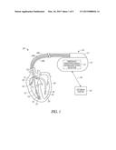 METHODS AND APPARATUS FOR DETECTING HEART FAILURE EVENT USING RANK OF     THORACIC IMPEDANCE diagram and image