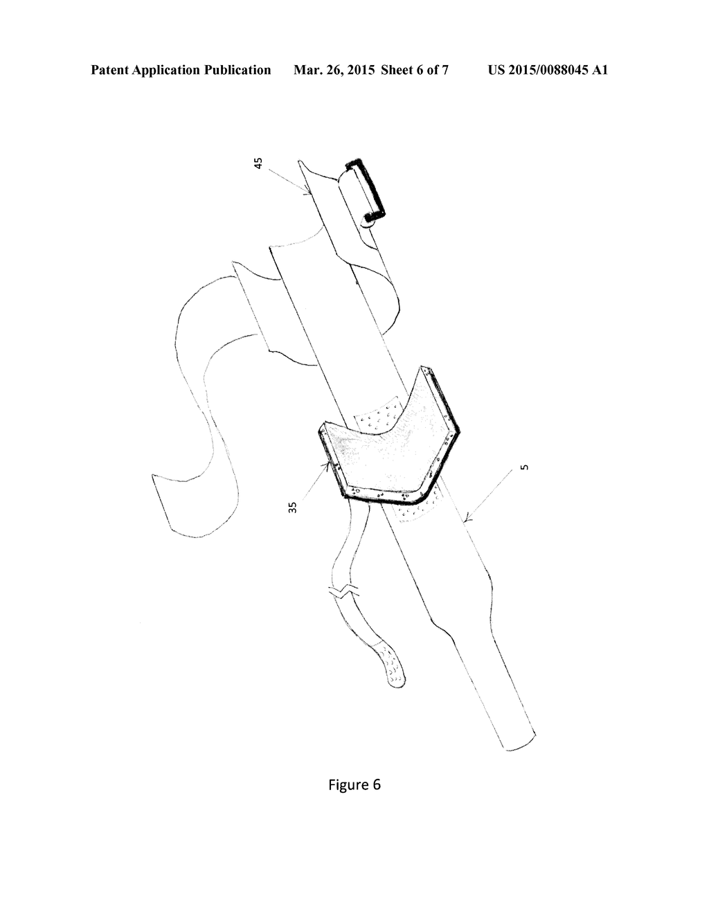 APPARATUS AND METHOD FOR TREATMENT OF LATERAL EPICONDYLITIS (TENNIS ELBOW) - diagram, schematic, and image 07