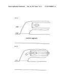 METHOD AND DEVICE FOR TREATING VENOUS INSUFFICIENCY AND VARICOSE VEINS diagram and image