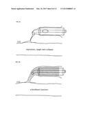 METHOD AND DEVICE FOR TREATING VENOUS INSUFFICIENCY AND VARICOSE VEINS diagram and image