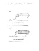 METHOD AND DEVICE FOR TREATING VENOUS INSUFFICIENCY AND VARICOSE VEINS diagram and image