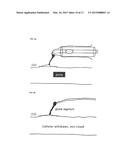 METHOD AND DEVICE FOR TREATING VENOUS INSUFFICIENCY AND VARICOSE VEINS diagram and image