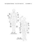 RENAL NEUROMODULATION METHODS AND SYSTEMS FOR TREATMENT OF     HYPERALDOSTERONISM diagram and image