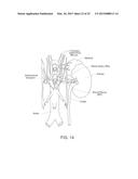 CRYOTHERAPEUTIC DEVICES FOR RENAL NEUROMODULATION AND ASSOCIATED SYSTEMS     AND METHODS diagram and image