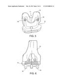 PATIENT SPECIFIC INSTRUMENT diagram and image