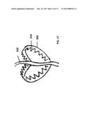 SUTURE FOR SOFT TISSUE REPAIR diagram and image