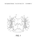 Method of Using Spine Stabilization System With Dynamic Screw diagram and image