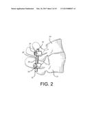 Method of Using Spine Stabilization System With Dynamic Screw diagram and image