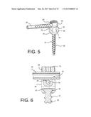 Method of Using Spine Stabilization System With Dynamic Screw diagram and image