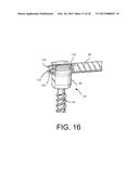 Method of Using Spine Stabilization System With Dynamic Screw diagram and image