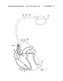 IMPLANTABLE CARDIAC STIMULATION DEVICE AND METHOD THAT STABILIZES     VENTRICULAR RATE DURING EPISODES OF ATRIAL FIBRILLATION diagram and image