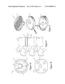 SPINAL IMPLANT diagram and image