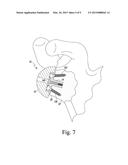 METHOD OF IMPLANTING A REVERSE SHOULDER ORTHOPAEDIC IMPLANT HAVING AN     ELLIPTICAL GLENOSPHERE COMPONENT diagram and image