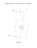 ELBOW PROSTHESIS diagram and image