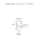 Implant for Restoring Normal Range Flexion and Kinematics of the Knee diagram and image