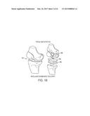 Implant for Restoring Normal Range Flexion and Kinematics of the Knee diagram and image