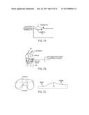 Implant for Restoring Normal Range Flexion and Kinematics of the Knee diagram and image