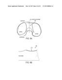 Implant for Restoring Normal Range Flexion and Kinematics of the Knee diagram and image