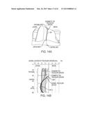 Implant for Restoring Normal Range Flexion and Kinematics of the Knee diagram and image