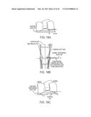 Implant for Restoring Normal Range Flexion and Kinematics of the Knee diagram and image