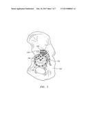 BONE AUGMENT INTERLOCKING WITH BONE PLATE diagram and image