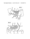 DEVICES AND METHODS FOR ENHANCING BONE GROWTH diagram and image