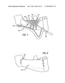 DEVICES AND METHODS FOR ENHANCING BONE GROWTH diagram and image